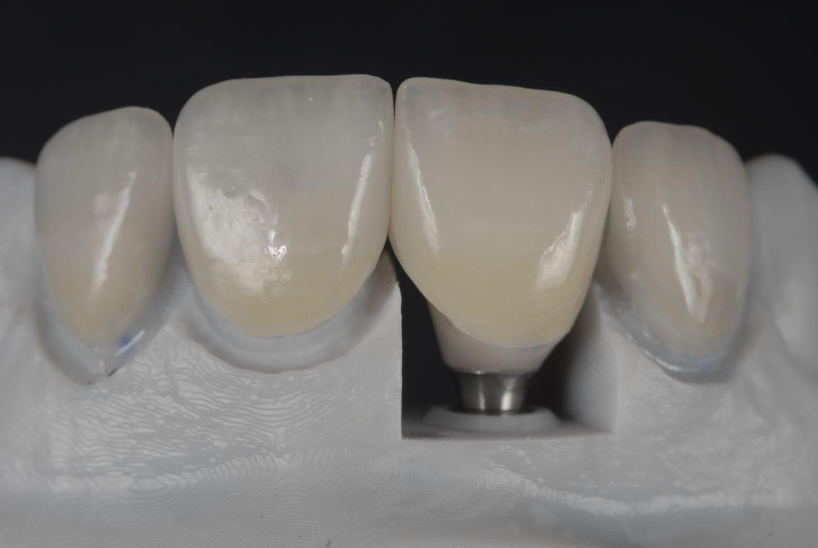 Implant-Supported Restoration